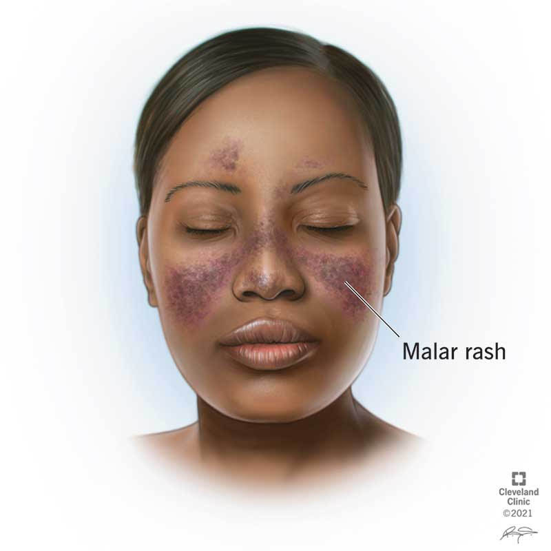 An example of a malar rash